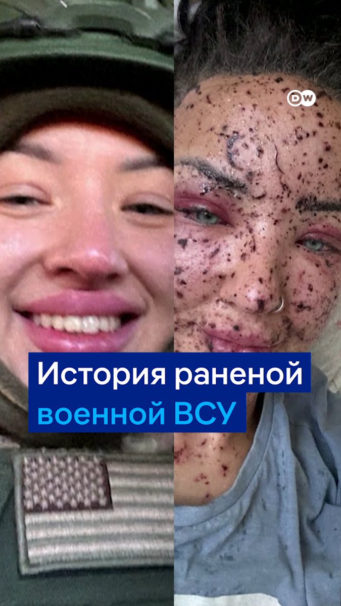 "До ранения я хотела что-нибудь изменить на своем лице, а после поняла, что я очень красивая". 23-летняя Яна служит в ВСУ, она получила серьезные ранения в результате атаки российским дроном. Лицо девушки сильно пострадало, и теперь она воспринимает себя по-другому