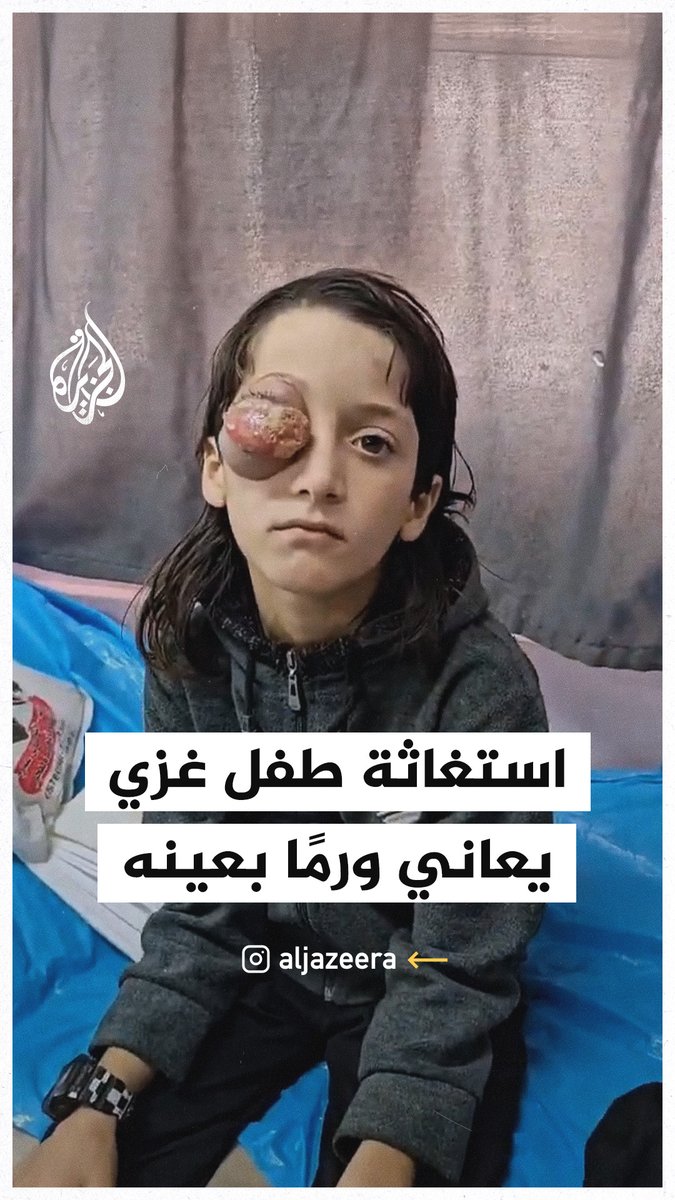"نفسي أسافر برا عشان أتعالج".. مناشدة طفل يعاني من ورم بعينه للعلاج خارج قطاع #غزة #حرب_غزة