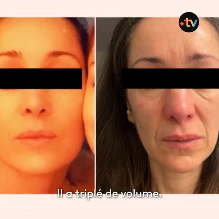 🔴 « Il m’a cassé le nez ! C’est de la mutilation volontaire ! » Le calvaire de Marilou, qui témoigne pour la première fois du cauchemar de sa rhinoplastie ratée par le chirurgien star, Olivier Gerbault. À retrouver ce soir dans #CLHebdo, dès 18:50 avec Louis Amar ⬇️