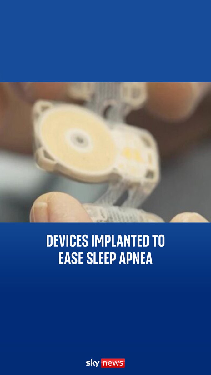UCLH implanted the first two patients in the UK with a small chip under the chin to help manage the airflow, as an estimated eight million adults in the UK are thought to have obstructive sleep apnea. Read Thomas Moore' full report 👉