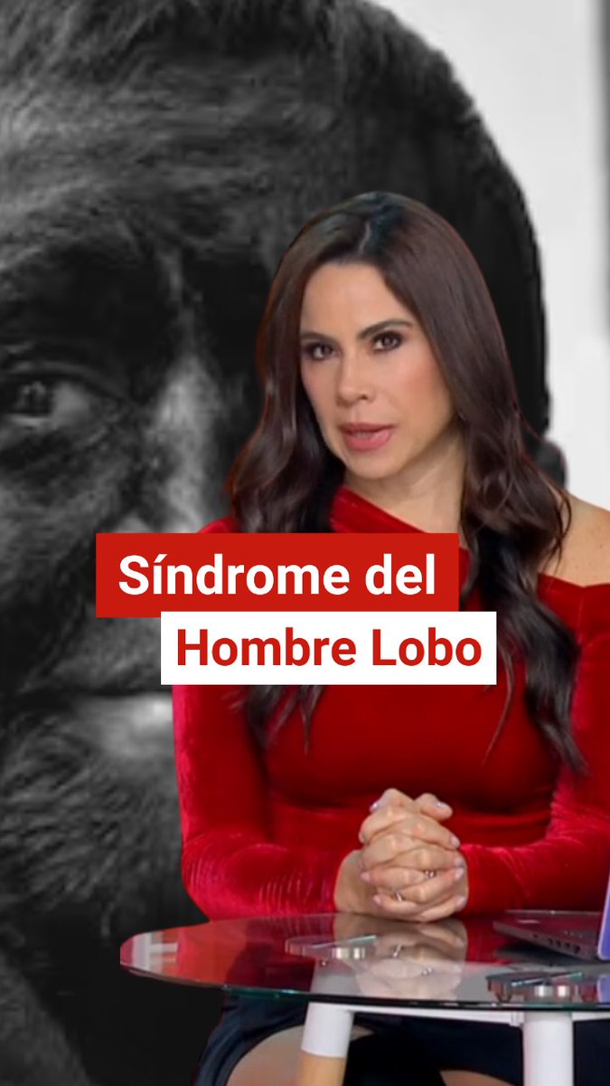 🐺⚠️ El síndrome del hombre lobo: alerta en Europa por el uso de Minoxidil. Se han detectado casos de hipertricosis en bebés debido al contacto con esta sustancia usada para la calvicie. De Pisa y Corre Imagen Televisión Imagen Noticias #Salud #Minoxidil #AlertaSanitaria #Dermatología