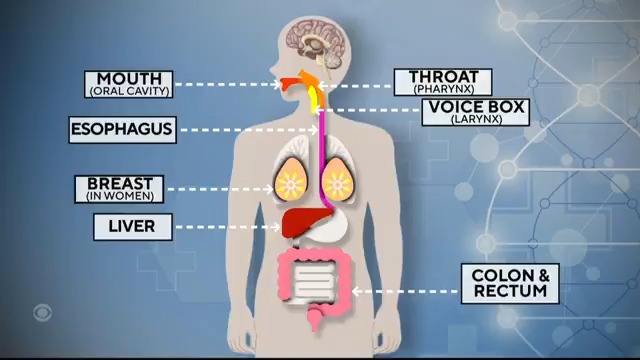 The Surgeon General is calling for cancer-risk warning labels to be placed on alcoholic beverages, citing a new advisory that says alcohol is a leading preventable cause of cancer. CBS News' Jonathan LaPook, M.D says the report warns that even one drink a day increases cancer risk.
