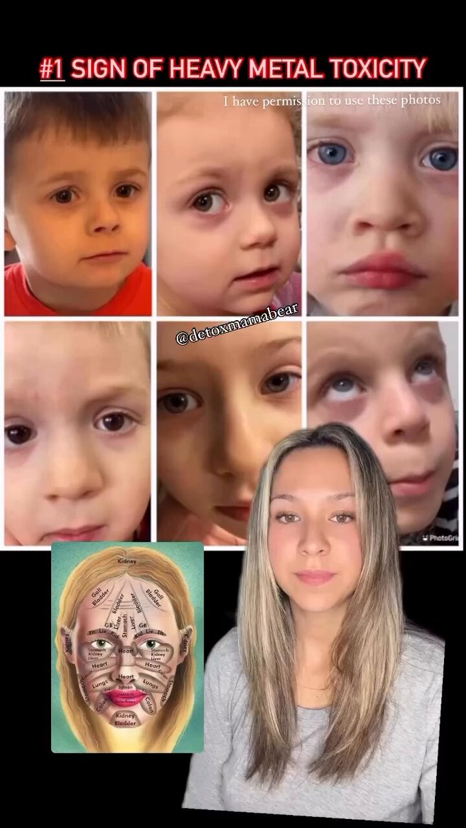 Signs you or your children need to heavy metals detox… We offer an 11 ingredient heavy metals / toxins binder
