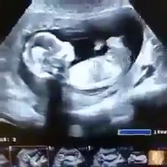 Abortion is the leading cause of death in the world.