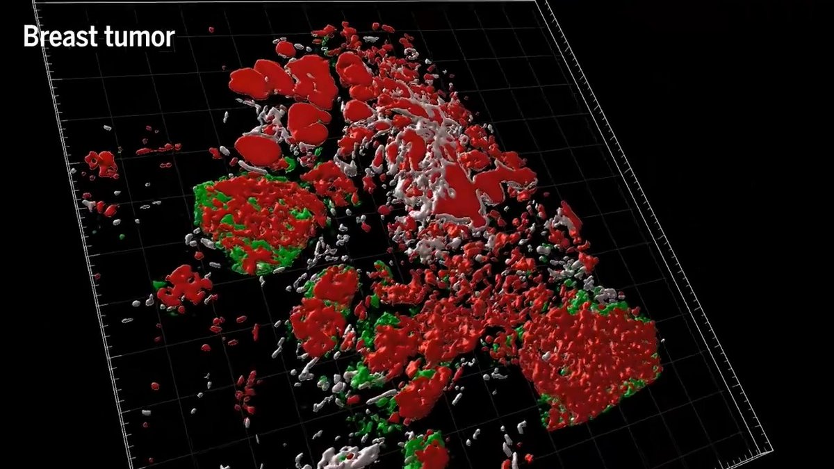 3D tumor maps give researchers an unprecedented look at cancer growth. Learn more: News from Science