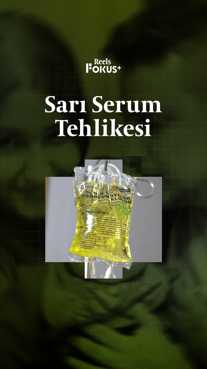➕ Son günlerde, halk arasında “sarı serum” veya “atom” olarak bilinen serum uygulamalarının ardından yaşanan ölümler dikkat çekiyor. ▪️ İstanbul’da 64 yaşındaki bir adamın evde sarı serum aldıktan sonra fenalaşarak hayatını kaybetmesi, bu konuya dair endişeleri artırdı. ▪️ Son bir hafta içinde aynı sebeple üç kişinin daha hayatını kaybettiği bildirildi. ▪️ Peki, sarı serum nedir?