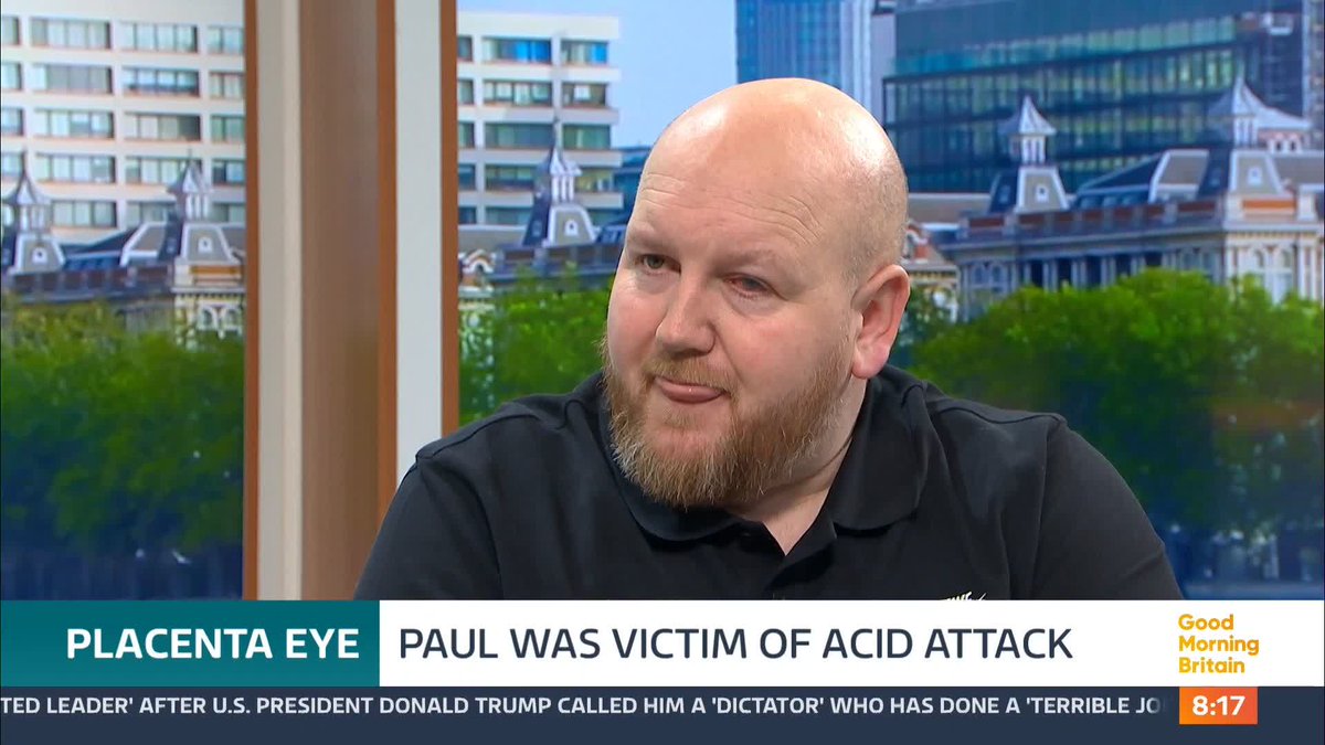 Medics were able to use a woman's donated placenta to save Paul Laskey's eye from deteriorating after he was attacked with battery acid in 2023. NHS Organ Donation 💗🫀🫁