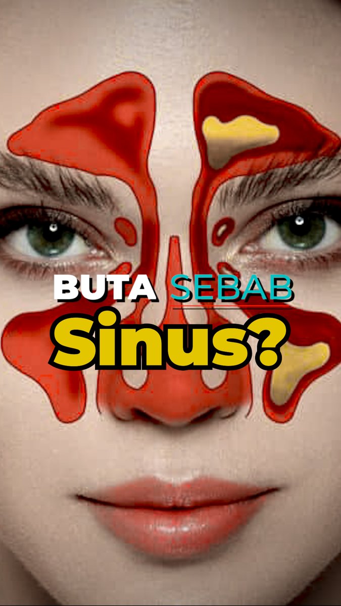 BUTA SEBAB SINUS? Laporan ini bertujuan memberi kesedaran tentang bahaya sinus yang selalu dianggap remeh seperti selsema dan alahan biasa tanpa rawatan khusus. #BernamaNews #Sinus #orbitalcellulitys #Awareness