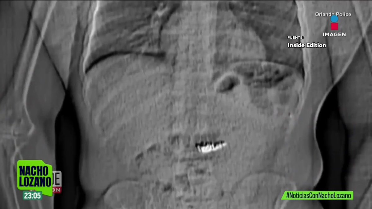Un ladrón se tragó unos aretes Tiffany con diamantes antes de ser arrestado en #Florida. Intentó ocultar las joyas valuadas en unos 770 mil dólares, pero aún así lo detuvieron. Así se ven los aretes en su estómago: