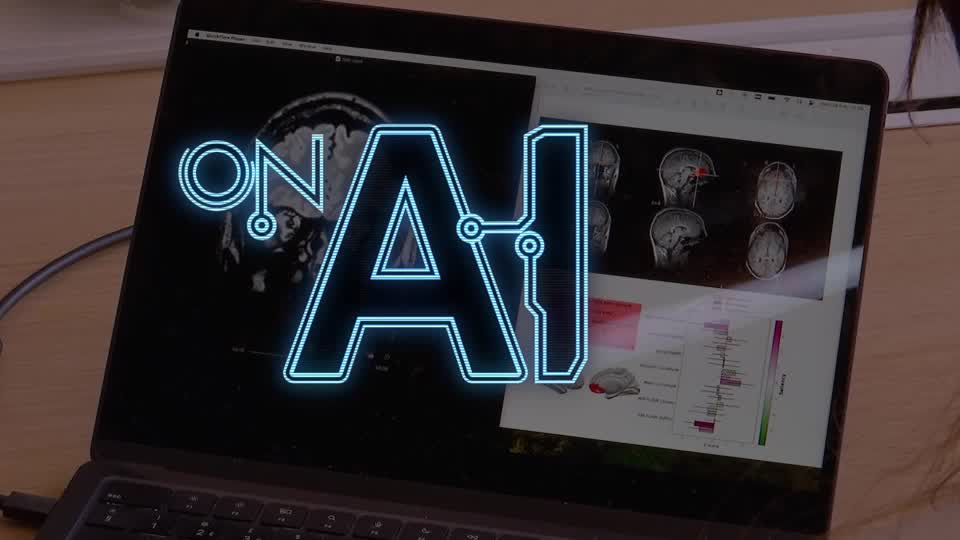 Scientists in London say they are using AI to detect difficult-to-spot brain abnormalities that cause epilepsy. The tool, called MELD Graph, came together with the help of 23 hospitals around the world that shared their records of brain abnormalities with researchers