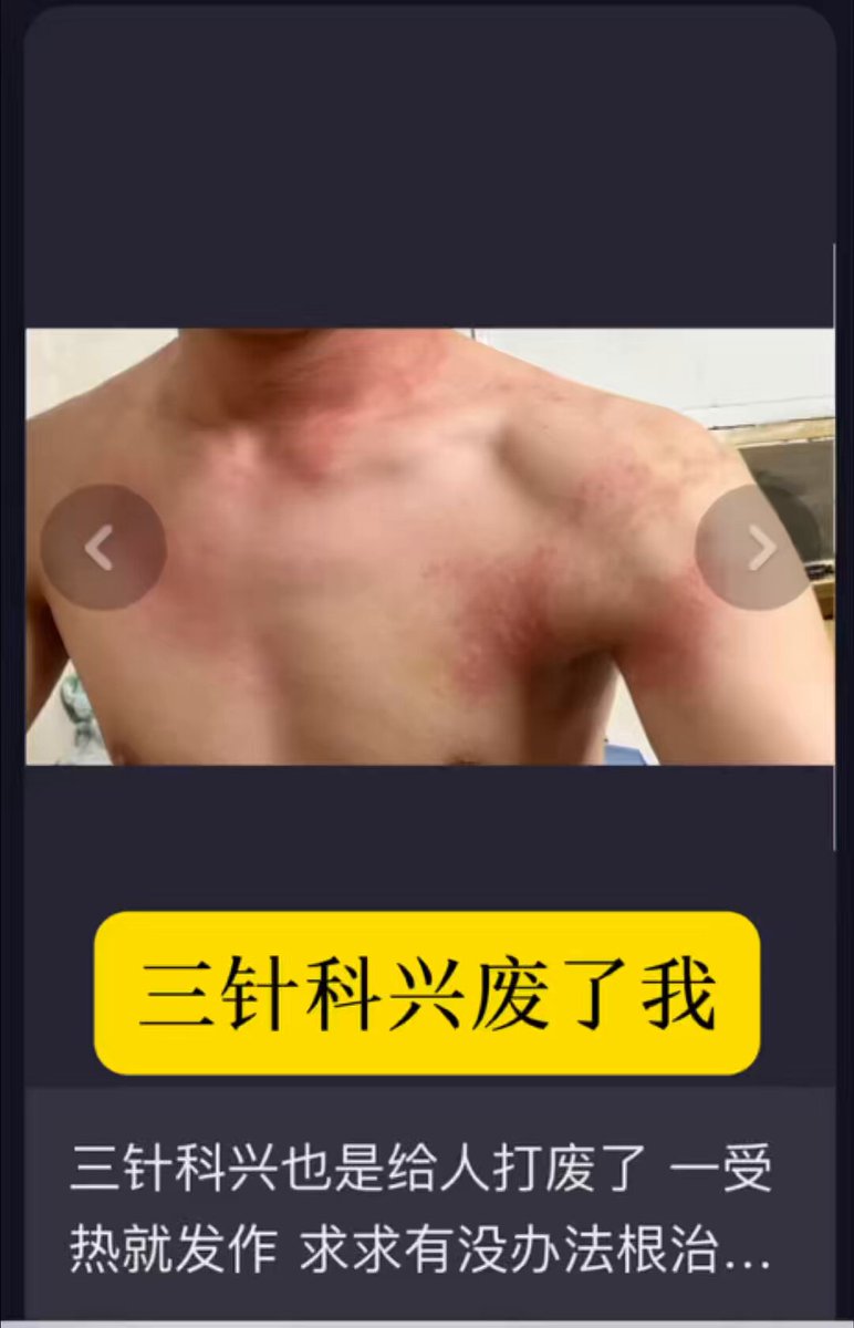 “三针科兴，也是给人打废了，一受热就发作，求求有没办法根治⋯” 评：之前有一位受害者，打新冠疫苗后皮肤病发作全身既痒又痛，有时甚至要用火烧肉体止痛。