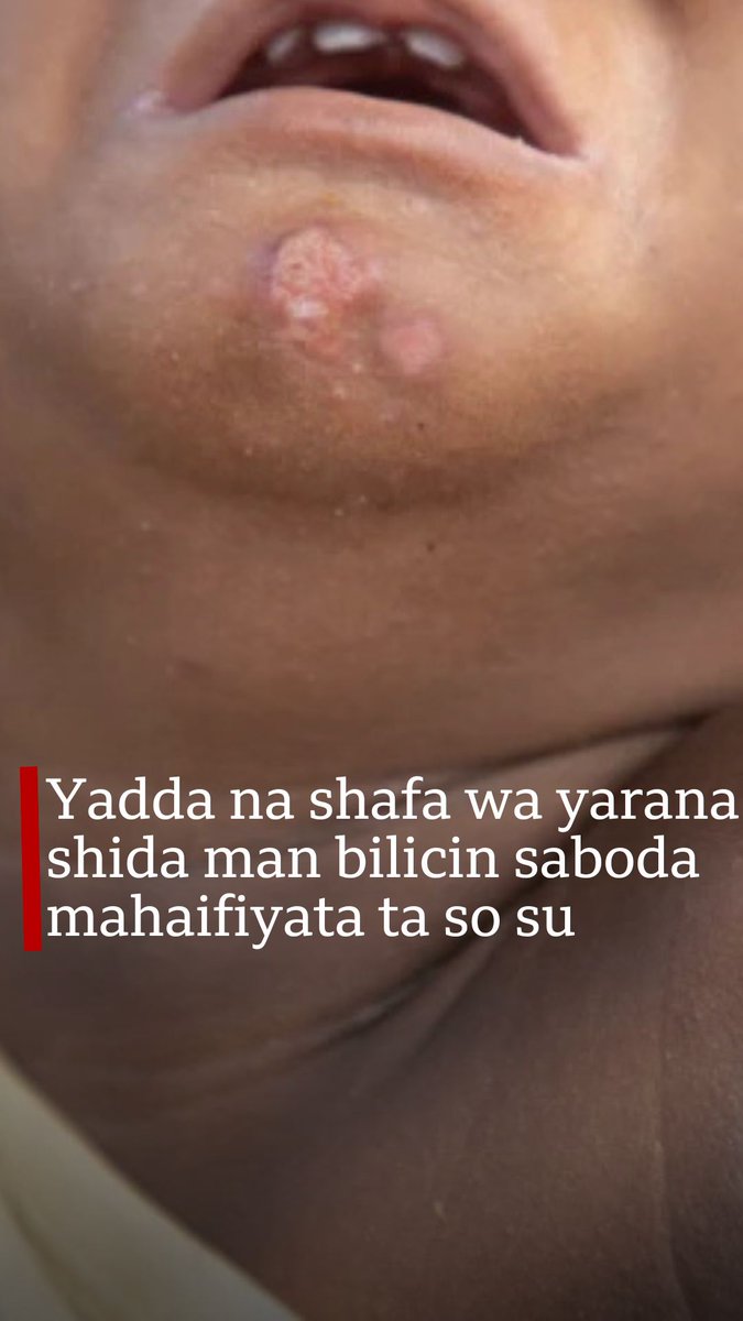 A Najeriya akwai wani sabon yayi na shafa wa yara man bilicin da wasu iyaye ke yi, bisa haka ne Madina Maishanu ta ziyarci Kano, ɗaya daga cikin biranen da lamarin ya fi ƙamari. Ta haɗu da wata mata wadda ta shafa wa yaranta 6 man bilicin, da yadda ake haɗa man a wata kasuwa.
