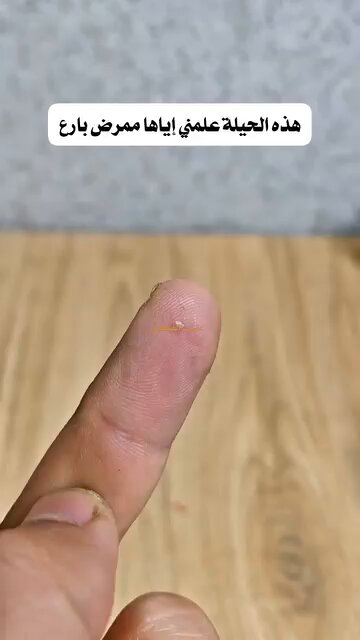 احفظها: طريقة ذكية لإزالة الشوك العالق 👌🏻