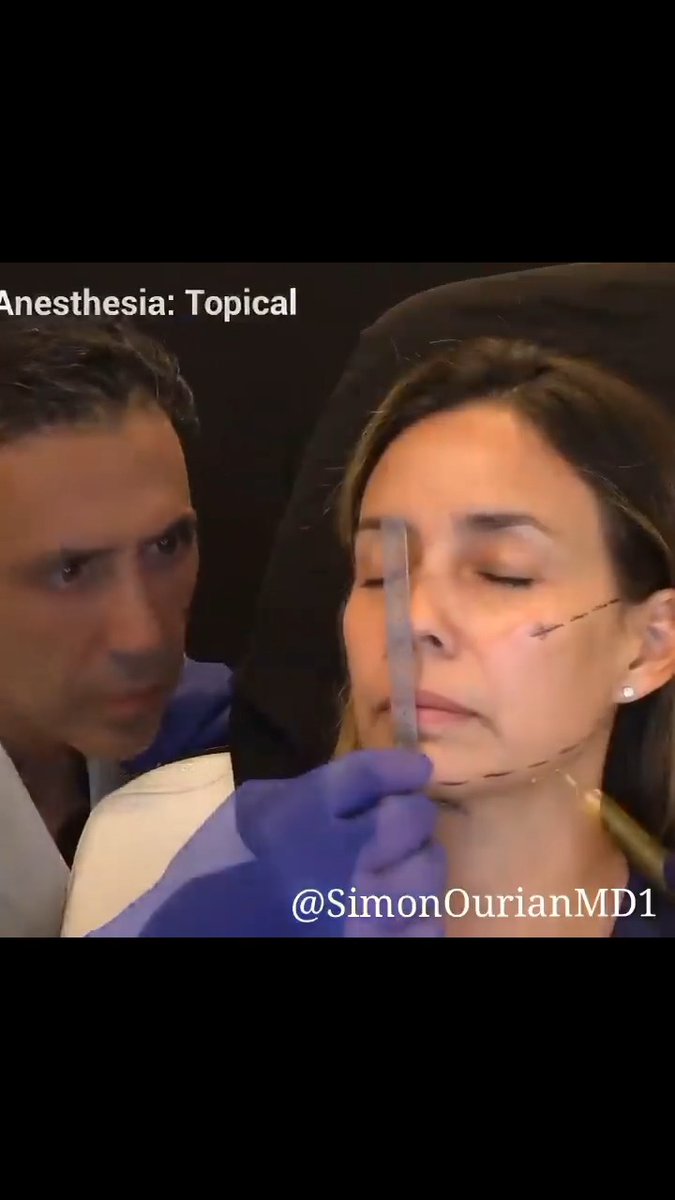 Did you know? Neustem, when expertly administered, can redefine facial contours and elevate your natural beauty—without ever looking overdone. And depending on how your body responds, the results can last semi-permanently. Experience the ultimate blend of science and artistry. Don’t just dream about the perfect look—achieve it. Visit to schedule an appointment with us. #Neustem #FacialContouring #NaturalBeauty #AestheticMedicine #BeautyEnhancement #DrSimonOurian #Epione #NonSurgical #GlowUp #LuxuryAesthetics #SkinGoals #ScienceMeetsArt #BeverlyHillsBeauty
