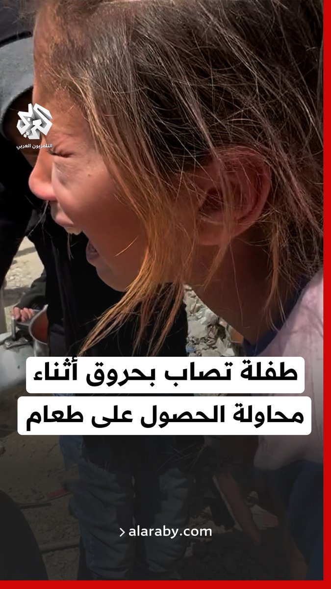 طفلة تصاب بحروق أثناء محاولتها الحصول على الطعام في #غزة
