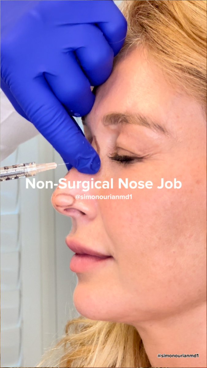 Thinking about a non-surgical nose job? 💉 ✨ Here’s how the process works at Epione Beverly Hills. Visit to schedule an appointment with us. #EpioneBeverlyHills #NonSurgicalNoseJob #FacialSculpting #LuxuryAesthetics #RefinedBeauty #DrSimonOurian #BeverlyHillsBeauty #NonInvasiveTreatment #AestheticExcellence