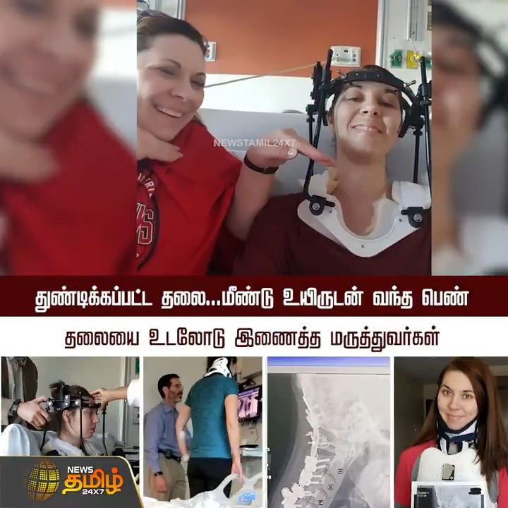 தலையை உடலோடு இணைத்த மருத்துவர்கள்.. மீண்டும் உயிருடன் வந்த பெண்...! #Doctor #Science #America #Surgery #SurgeryRecovery #Football #TamilNews #NewsTamil #NewsTamil24x7