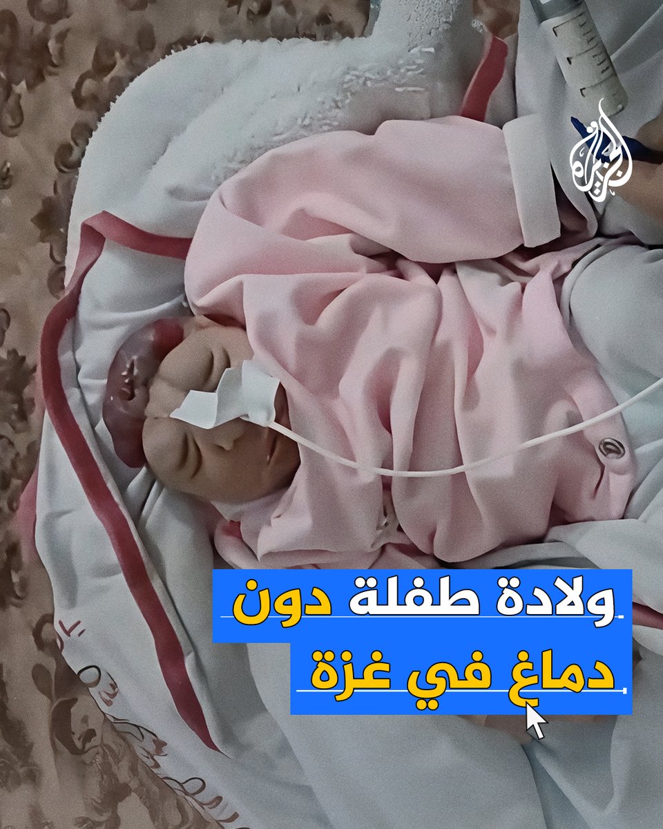 حالة وصفت بـ"الصادمة".. ولادة طفلة دون دماغ في #غزة مع تزايد حالات تشوه الأجنة منذ بداية الحرب الإسرائيلية على القطاع #حرب_غزة