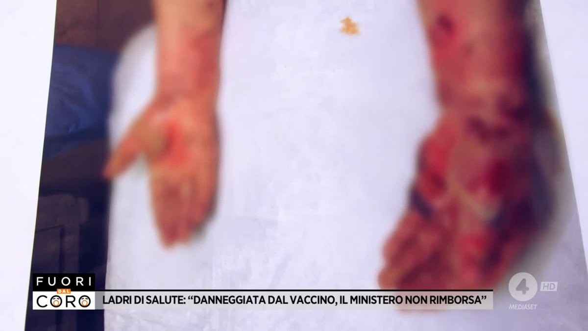 Giovanna, 82 anni, è sempre stata in perfetta salute ma subito dopo aver fatto il vaccino contro il covid ha iniziato a sentire un fuoco addosso e il suo corpo si è riempito di bolle, con dolore insopportabile con cui convive dal 2022. Marianna Canè #Fuoridalcoro