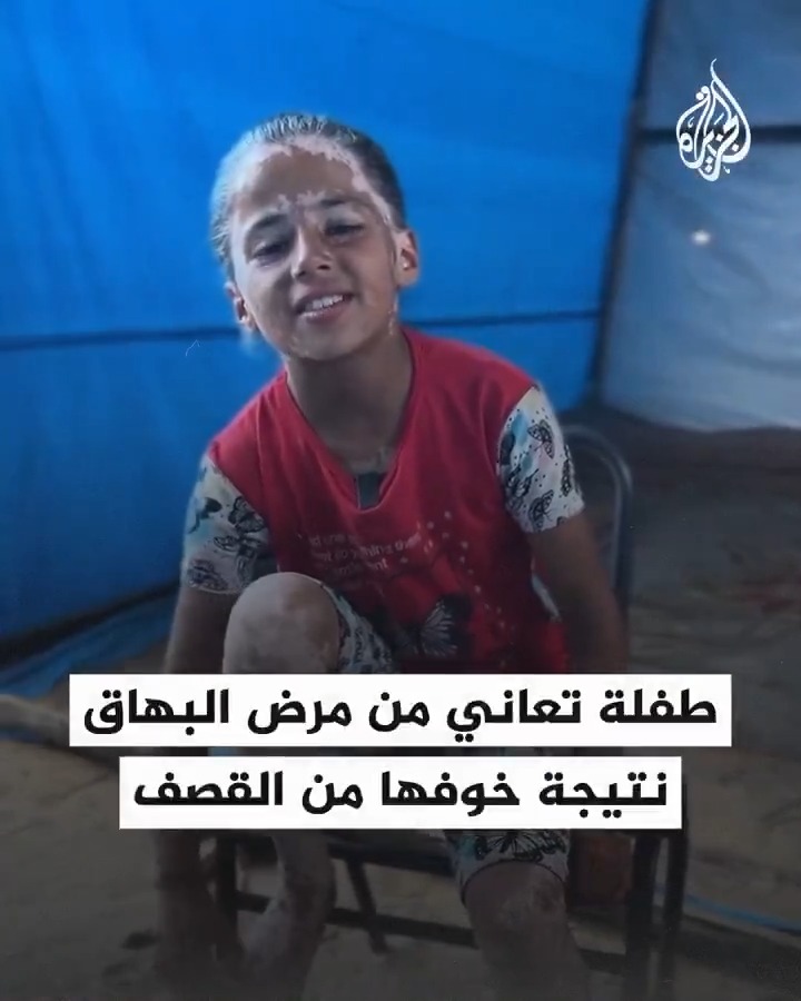 "كنت حلوة.. فجأة مع الخوف جلدي صار أبيض وشعري شاب".. الطفلة لانا الشريف من قطاع #غزة تتحدث عن إصابتها بمرض البهاق نتيجة خوفها من استمرار القصف الإسرائيلي واستهداف منزل ملاصق لمنزل عائلتها، وأمنيتها بالعلاج والرجوع لشكلها الجميل #حرب_غزة