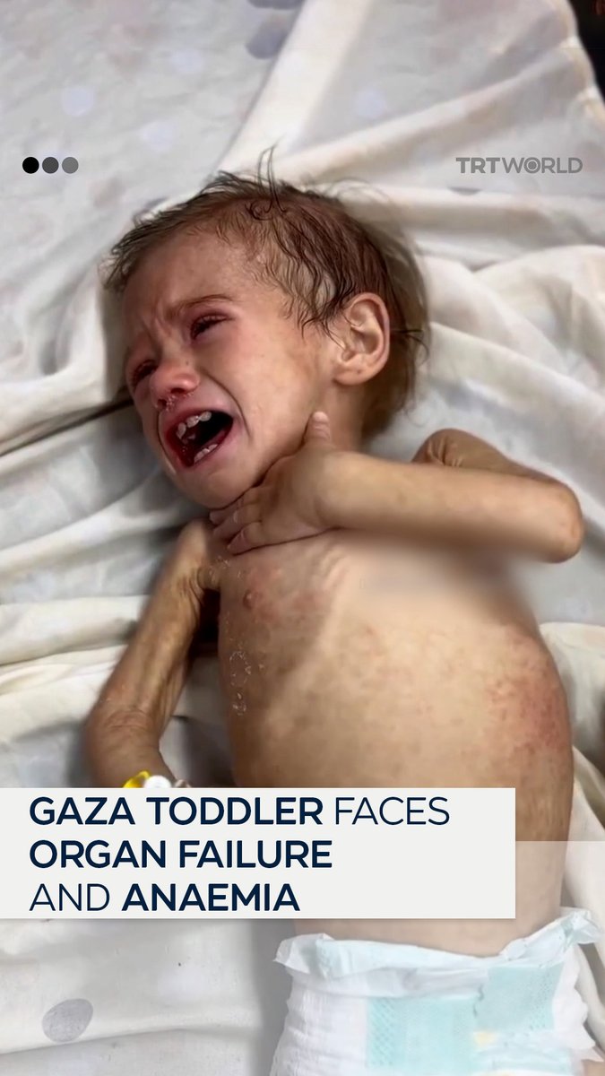 Maryam, a critically ill three-year-old in Gaza, has lost more than half her body weight due to an enlarged liver, kidneys and spleen, along with severe anaemia. Her father holds WHO approval for treatment abroad, but she remains stuck in Gaza. Her family is urgently appealing for help to evacuate her for life-saving care