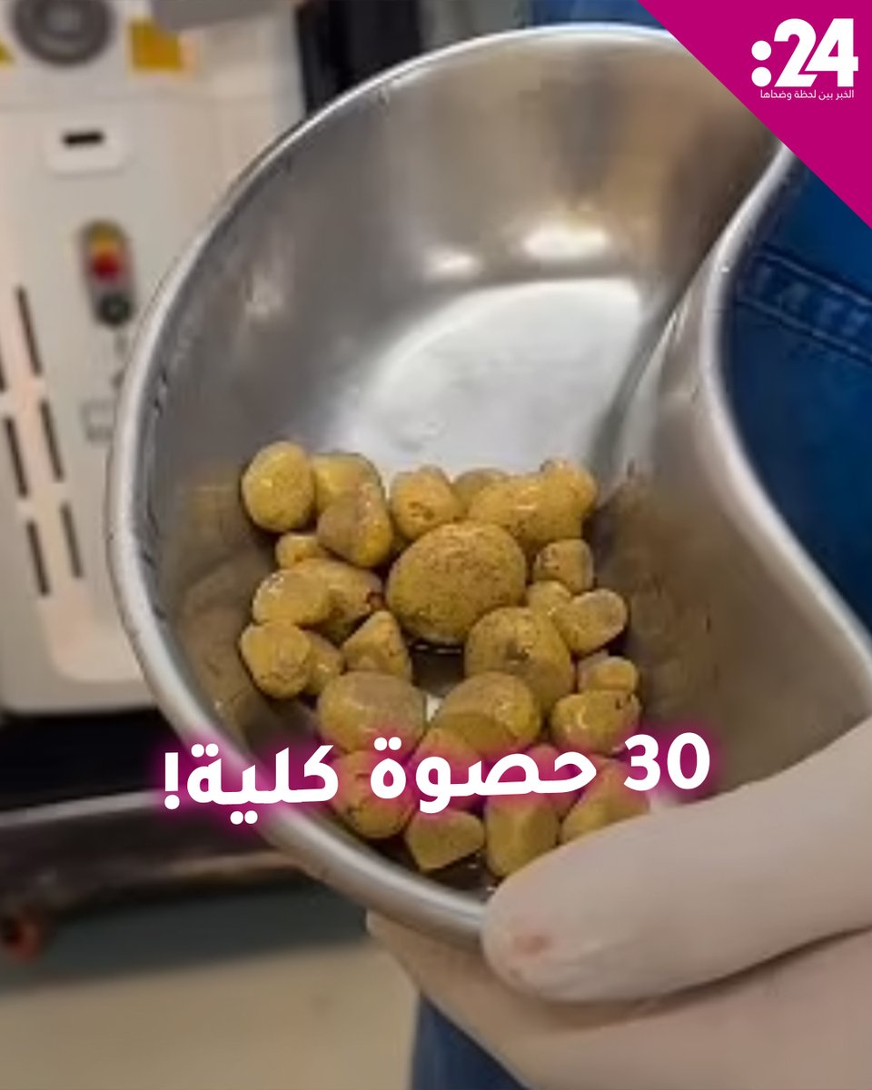 طبيب يستخرج 30 حصوة من كلية رجل سببها مشروب شهير! لمشاهدة المزيد من الفيديوهات: