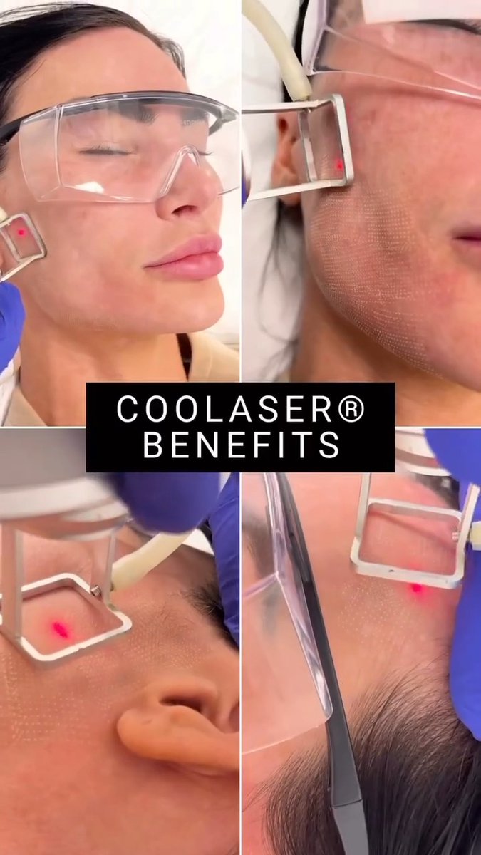 Our signature Coolaser® treatment is a powerful solution for pigmentation, acne scars, fine lines, and uneven texture—delivering luminous skin with minimal downtime. Exclusively performed by Dr. Simon Ourian in Beverly Hills, Coolaser® combines advanced technology with refined artistry for results that are as natural as they are transformative. Visit to schedule your consultation appointment with us. #CoolaserByDrOurian #EpioneBeverlyHills #SkinRejuvenation #LuxuryAesthetics #DrSimonOurian