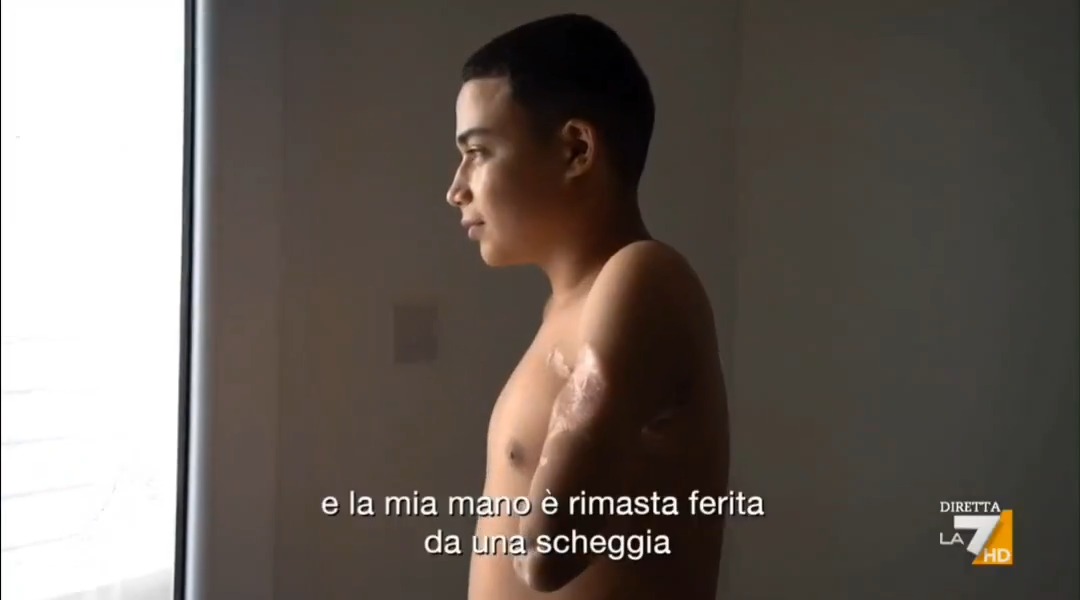 Il racconto di un bambino senza più il braccio a Gaza: "Mio cugino di un anno era morto davanti a me. Una scheggia gli ha tagliato la testa lasciandone metà sul pavimento. Correvamo verso l'ospedale in mezzo ai cadaveri in decomposizione" di F. Mannocchi #propagandalive