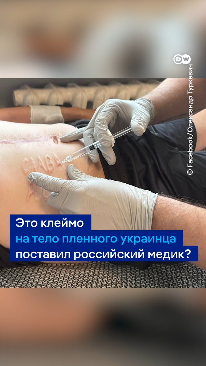 Фотография украинского военного, который вернулся из плена РФ с клеймом, шокировала многих. Украинский дерматолог Александр Туркевич рассказал DW, что ожог, скорее всего, был сделан с ведома российских медиков, а, возможно, даже и самим хирургом