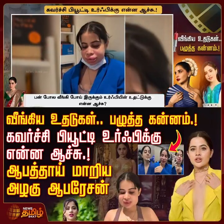 வீங்கிய உதடுகள்..பழுத்த கன்னம்.!கவர்ச்சி பியூட்டி உர்ஃபிக்கு என்ன ஆச்சு.! ஆபத்தாய் மாறிய அழகு ஆபரேசன் #Javedlip #Urfijaved #Operation #LipFillers #LipFillerGoneWrong #SwollenFace #LipFillerRemoval, #UrfiJavedControversy #TamilNews #NewsTamil #NewsTamil24x7