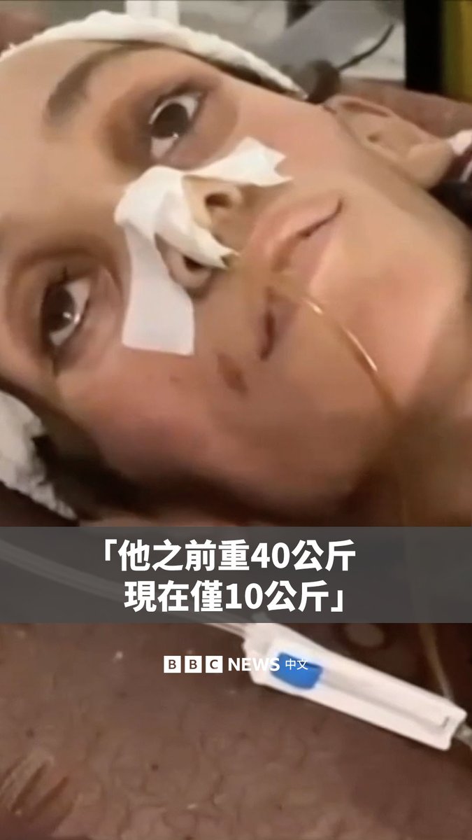 “他之前重40公斤，现在勉强仅10公斤。” 在加沙，由于封锁，当地人正面临着日益严重的营养不良和饥饿，而药物的缺乏使得治疗变得更加困难。 世界卫生组织（WHO）总干事谭德塞（Tedros Adhanom Ghebreyesus）表示，加沙地带正陷入一场“人为造成的大规模饥荒”。