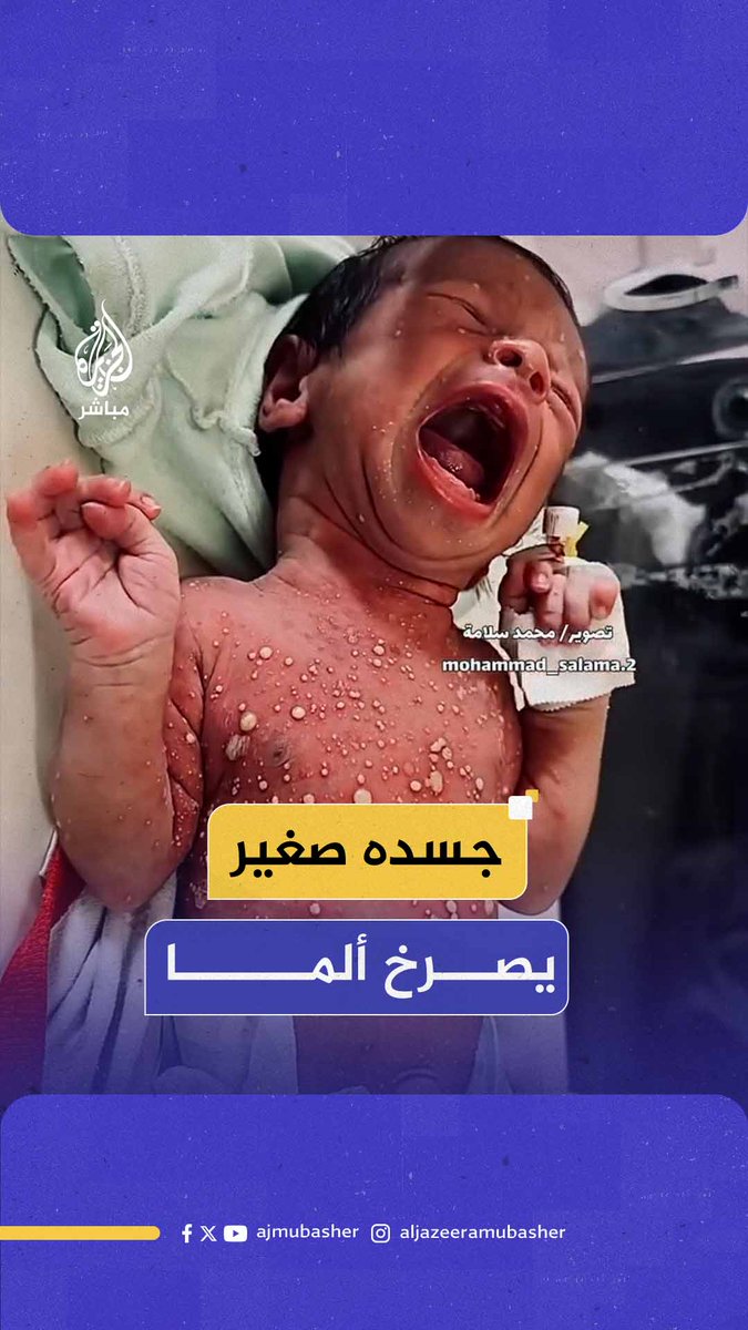 أجسادهم لم تعد تتحمل.. مشهد صعب لرضيع فلسطيني حديث الولادة وعلى جسده أعراض مرض جلدي نتيجة نقص الدواء جراء الحصار الإسرائيلي الخانق #الجزيرة_مباشر #غزة