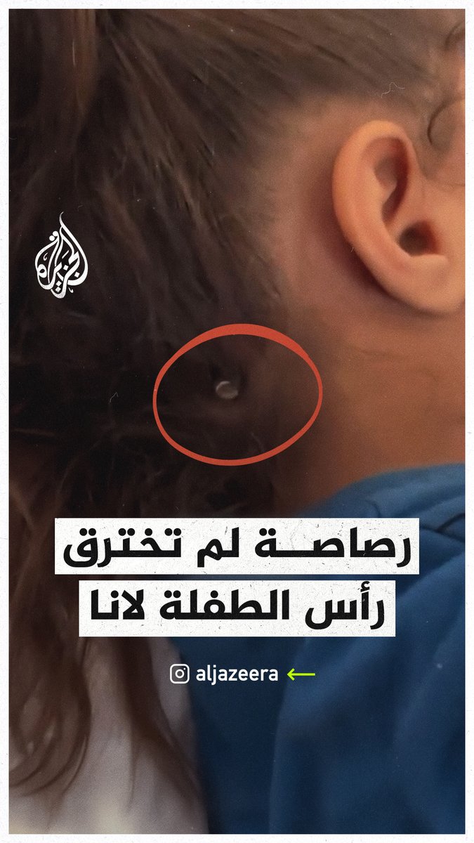 نجاة الطفلة لانا البسوس بعد إصابتها بطلق ناري في الرأس من مسيرة إسرائيلية في قطاع #غزة، حيث استقرت الرصاصة بين الجمجمة وفروة الرأس دون أن تخترقها #حرب_غزة