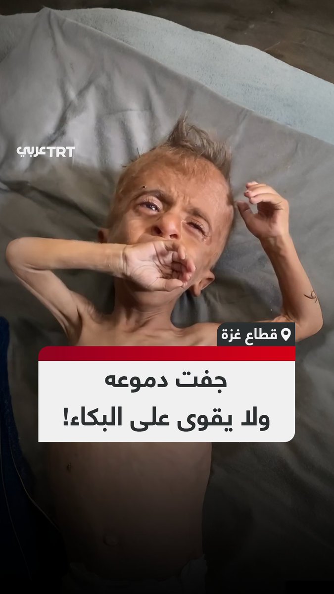 وزنه 6 كيلوغرامات فقط.. مشهد مؤلم للطفل محمد زكريا المعتوق (عام ونصف) الذي يعاني من سوء تغذية حاد نتيجة التجويع والحصار الذي يفرضه الاحتلال الإسرائيلي على قطاع غزة #تفاعل ليصل إليك كل جديد