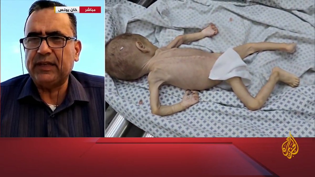 مدير مستشفى الأطفال بمجمع ناصر في #غزة للجزيرة: سوء التغذية أصبح أمرا عاديا في ظل تزايد الحالات يوميا بالقطاع، والأطفال سيحتاجون وقتا طويلا للتعافي من سوء التغذية #الأخبار #حرب_غزة