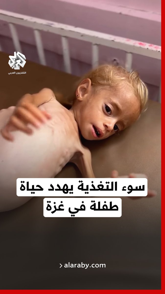 سوء التغذية يهدد حياة الطفلة شام قديح البالغة عامين من العمر في #غزة، إذ تحول جسدها إلى هيكل عظمي وأصبح وزنها نحو 4 كيلو غرامات فقط