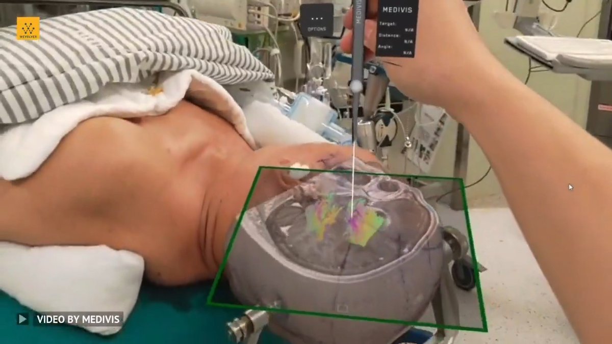 AIと拡張現実(AR)を組み合わせた外科手術支援システム「SurgicalAR」 MRIやCTスキャンなどの複雑な2D画像を、リアルタイムで3Dビジュアライゼーションに変換し、患者の体に重ねて表示できる技術でベッドサイドで手術や診断をより正確に行えるようになる