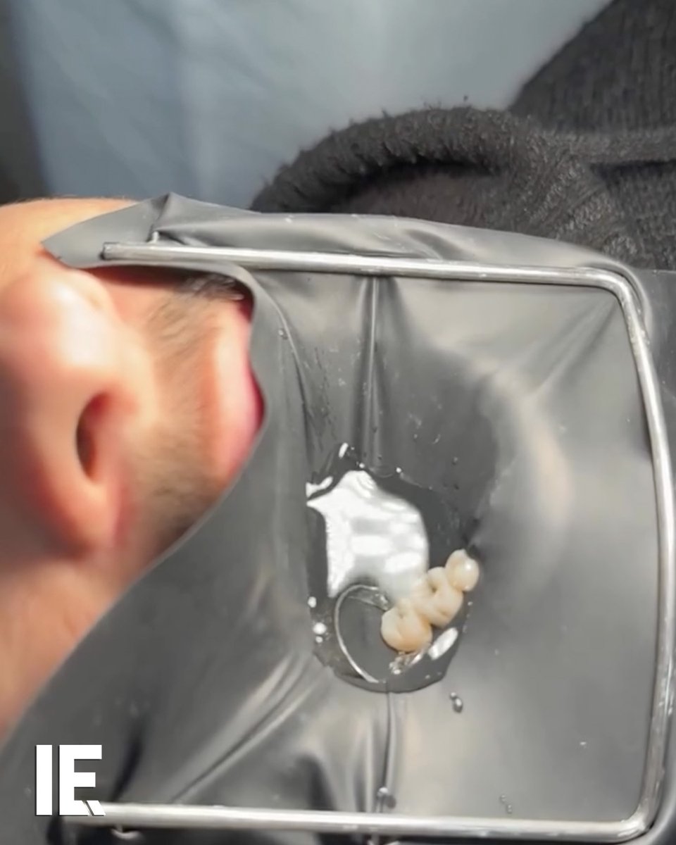 This rubber dam is actually a crucial step when it comes to dentistry! 🎥 dentistry.blogg / IG
