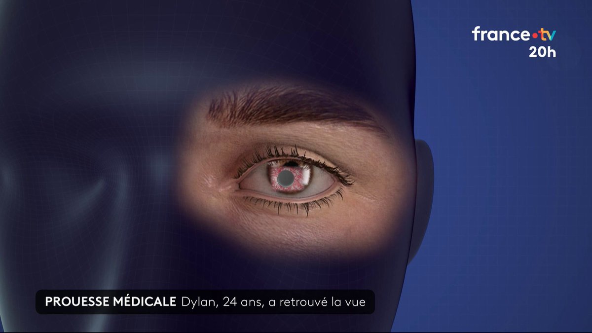 🚨🇫🇷👁️🦷 ALERTE INFO ! IL RETROUVE LA VUE GRÂCE À UNE DENT 😱 Dylan, 24 ans, aveugle depuis 12 ans, a retrouvé la vue grâce à une opération révolutionnaire et unique en France : un morceau de dent greffé dans son œil. 🇫🇷👏