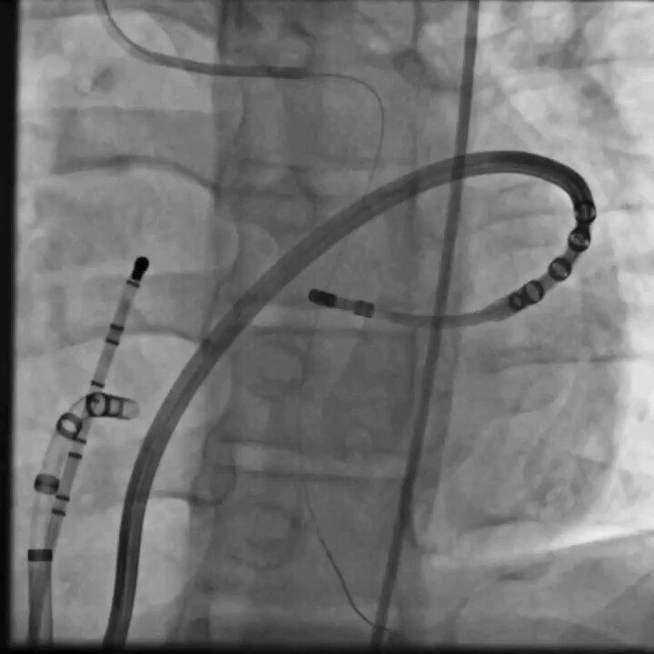 16y/o boy with high-burden VA referred for EP study. Endocardial mapping at RV apex (92% QRS match) caused #RBBB but VA persisted. Epicardial mapping identified origin at mid-anterior interventricular groove. #JACCCaseReports