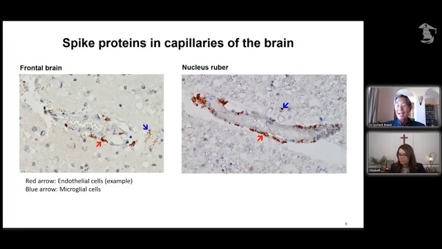 "The brain cells are dead and dying." Dr Bhakdi show us the cross section of capillaries of the brain of a 77 year old man who died after his 3rd Covid vaccine (Pfizer). Spike protein was found in the small vessels of the brain. Lymphocytes were found in the brain tissue. "Lymphocytes should not be in the brain tissue." Spike stain used, there was no nucleocapsid. It was the vaccine not the virus. Paper by Morz, 2022.