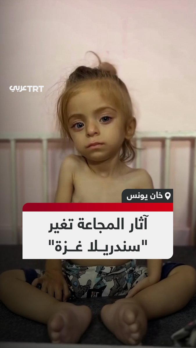 أصبح جسدها هزيلاً وظهرت عظامها.. سوء التغذية نتيجة المجاعة التي فرضها الاحتلال على قطاع غزة سابقاً، يهدد حياة الطفلة سيلين وادي التي تعرف بـ"سندريلا غزة" مع استمرار الحصار ونقص الأدوية. #تفاعل ليصل إليك كل جديد