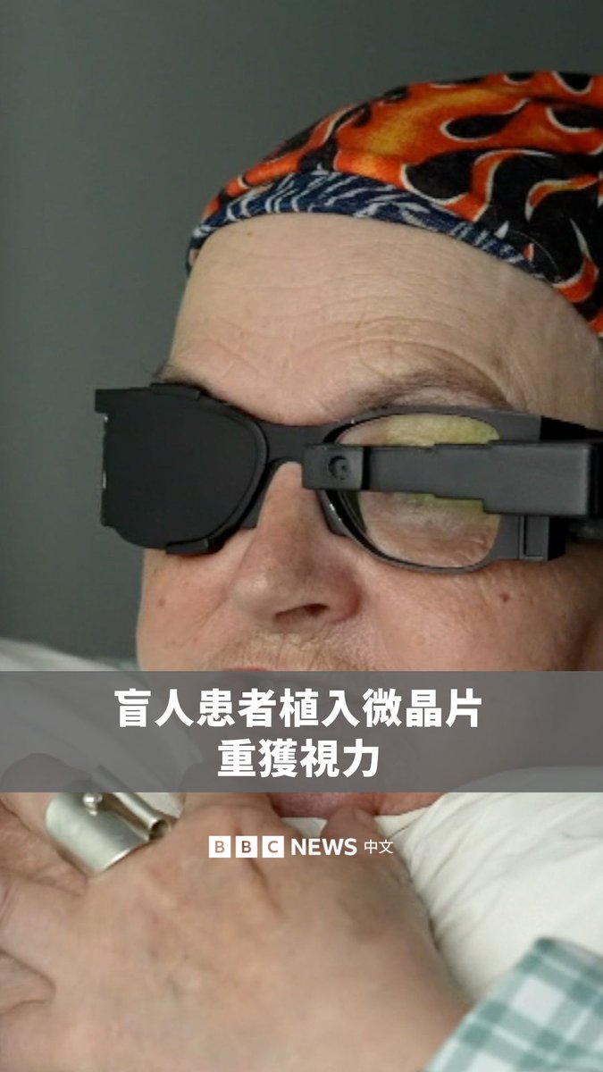 70岁的希拉·欧文患有干性年龄相关性黄斑病变,意味着她眼睛后方的某些细胞已经受损并死亡。但当她在眼中植入微型晶片,并戴上一副特制眼镜后,终于重获视力,因该副眼镜会将画面讯号传送到植入在她视网膜下的晶片,让她得以看见清晰画面。