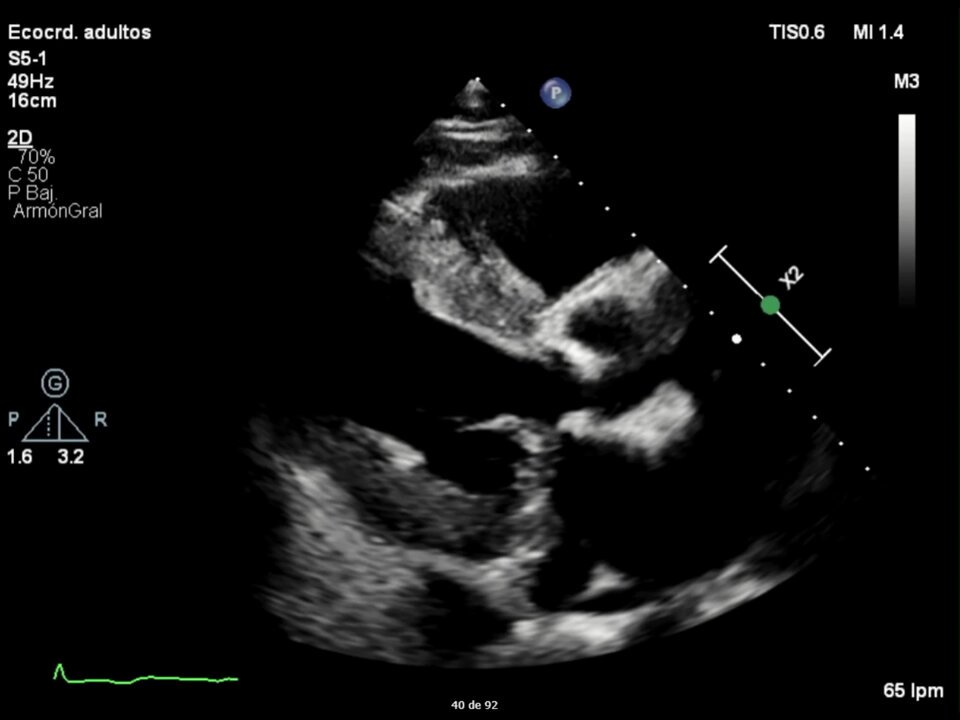A 79-years-old man with recent onset dyspnea. What is the diagnosis? #echofirst