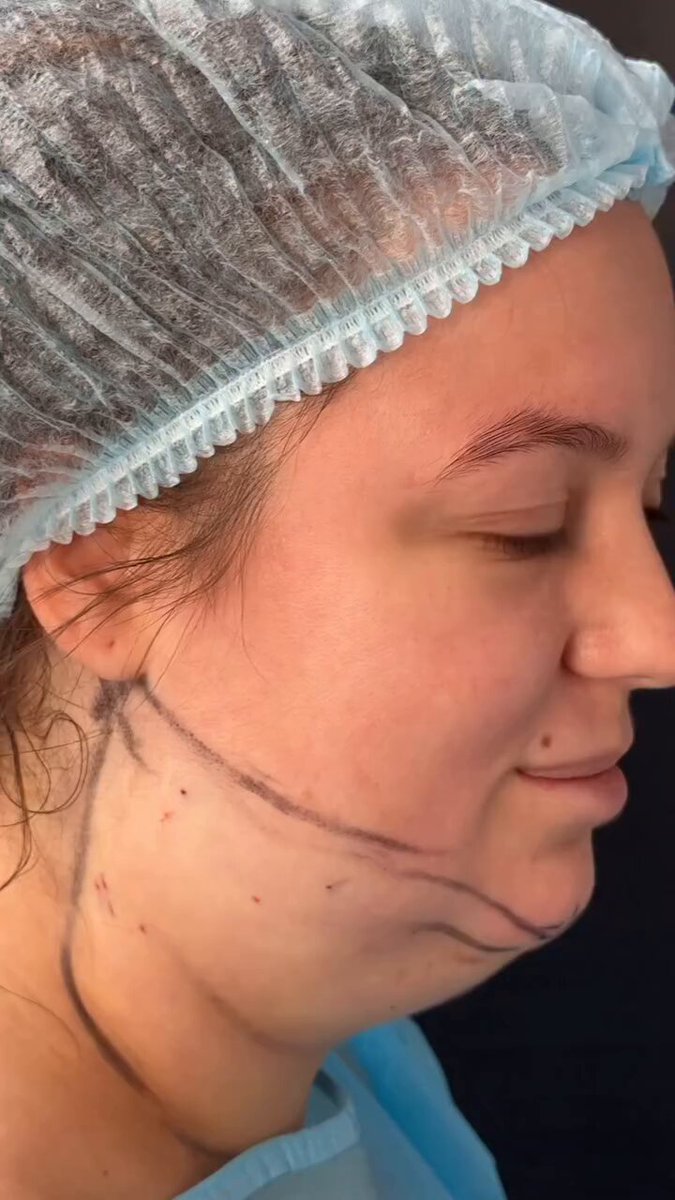 O procedimento de lifting facial rejuvenesceu ela em 20 anos, disse a Dra 👌