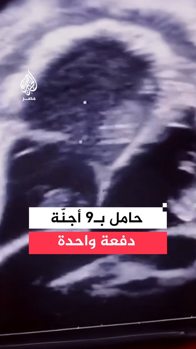 سيدة تحمل في 9 توائم دفعة واحدة.. والطبيب المعالج يقول إن السبب هو استخدام أدوية لتنشيط المبايض دون متابعة طبية دقيقة، ويؤكد متابعة حالتها بشكل لحظي
