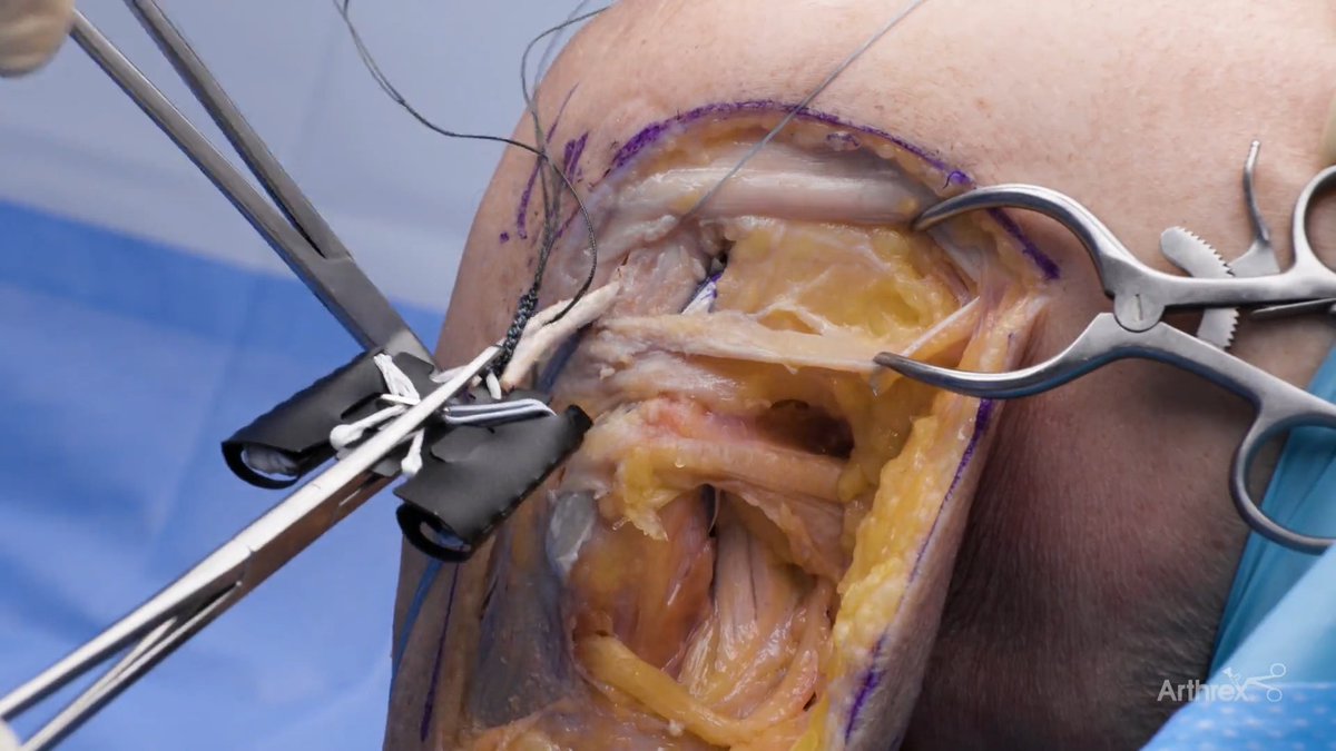 Michael Alaia, MD, demonstrates a posterolateral corner (PLC) reconstruction using Collateral Ligament FiberTag® TightRope® implants with the InternalBrace™ technique. The new Collateral Ligament FiberTag TightRope implants were optimized for extra-articular knee ligament procedures by using a new, smaller FiberTag implant and atraumatic tapered needles for graft preparation. Watch the full video: #Arthrex #MedicalEducation *The InternalBrace surgical technique is intended only to augment the primary repair/reconstruction by expanding the area of tissue approximation during the healing period and is not intended as a replacement for the native ligament. The InternalBrace technique is for use during soft tissue-to-bone fixation procedures and is not cleared for bone-to-bone fixation.