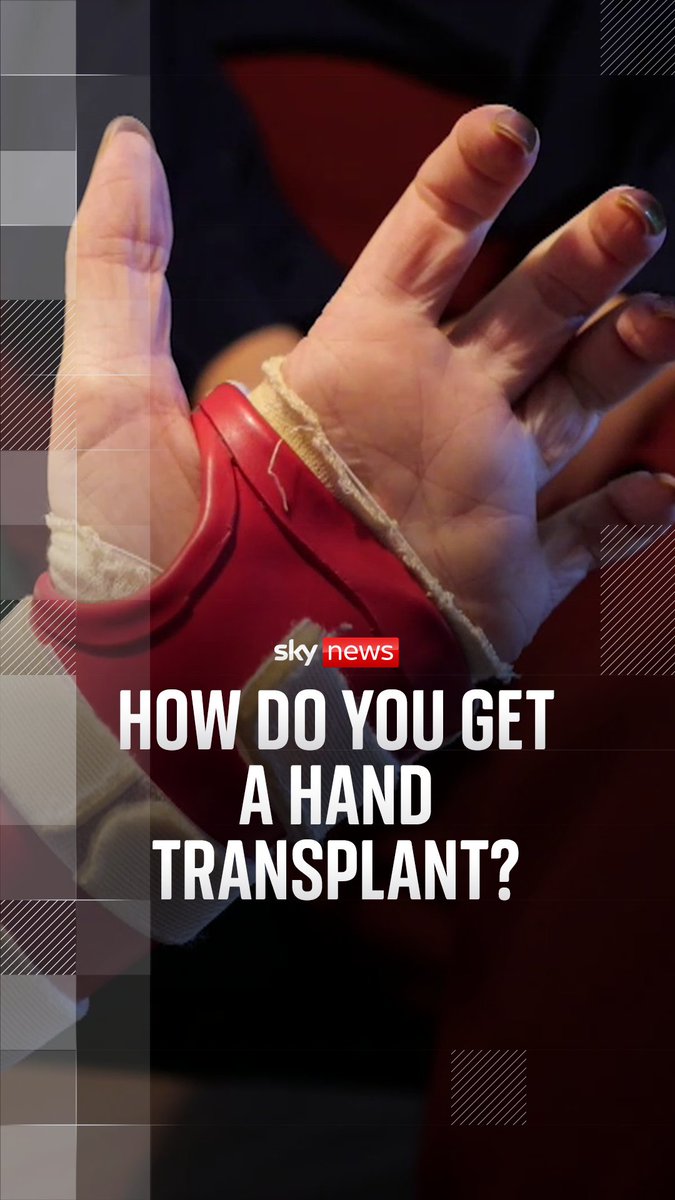 Sky News has followed the story of Kim who underwent a hand transplant after she had her limbs amputated following sepsis. A transplant of hands is one of the rarest and most unusual operations. Sky's Laura Bundock explains why Watch the full documentary