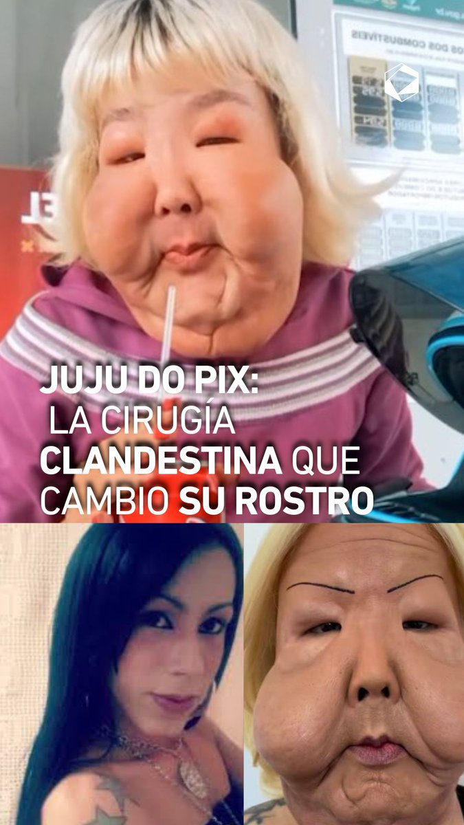 Buscaba mejorar su apariencia, pero un procedimiento ilegal le enseñó la importancia de priorizar la salud. 🫀 Tu bienestar siempre va primero.