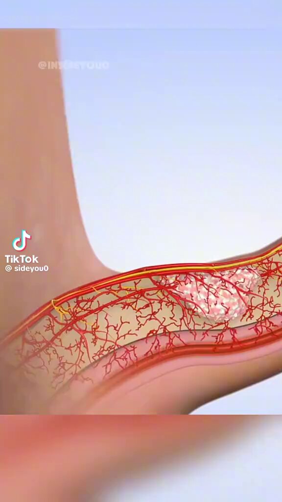 5 foods that may worsen peyronie’s disease!